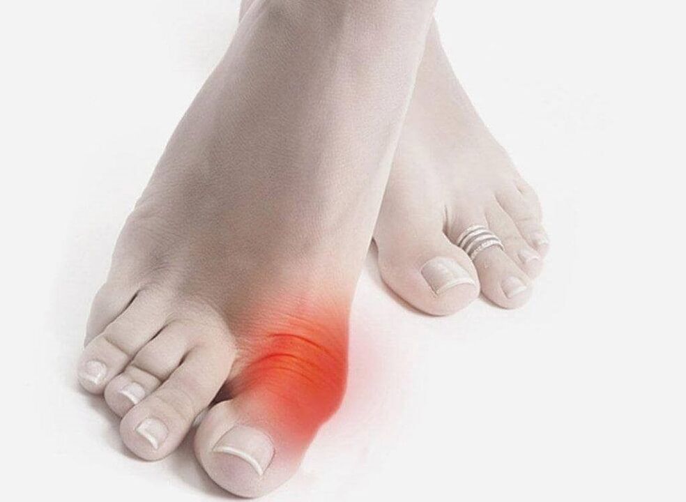sintomi del piede di gotta